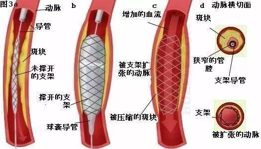 缆线支架