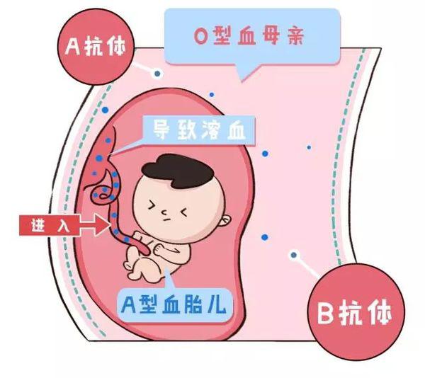 abo溶血是在肚子里就溶血吗